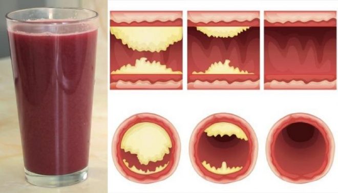 This Simple Drink Will Unclog Arteries And Protects Against Heart Diseases
